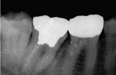 精密根管治療症例