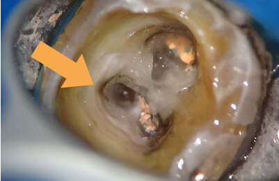精密根管治療症例