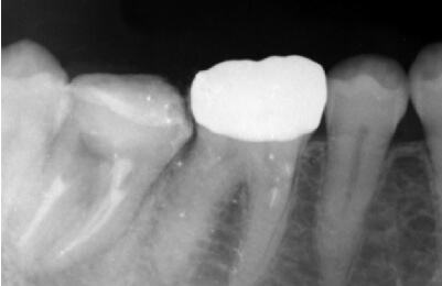 精密根管治療症例