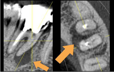 精密根管治療症例