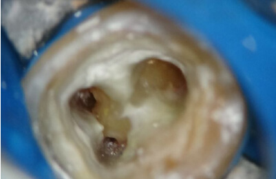 精密根管治療症例