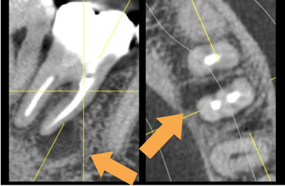 精密根管治療症例