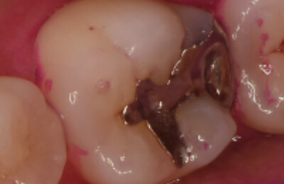 歯髄温存療法症例