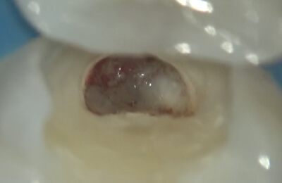 歯髄温存療法症例
