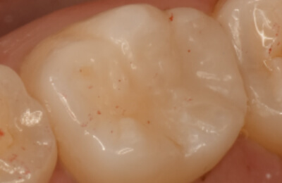 歯髄温存療法症例