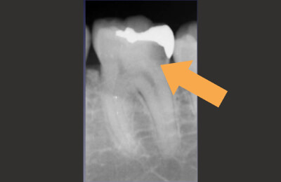 歯髄温存療法症例