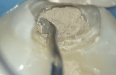 歯髄温存療法症例