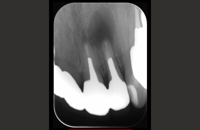 外科的歯内療法症例