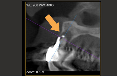 外科的歯内療法症例