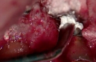 外科的歯内療法症例