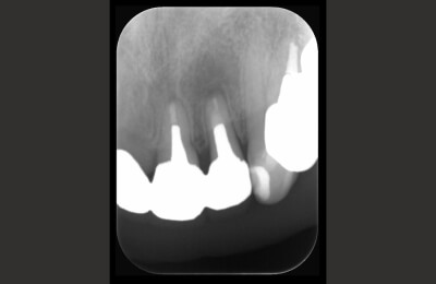 外科的歯内療法症例