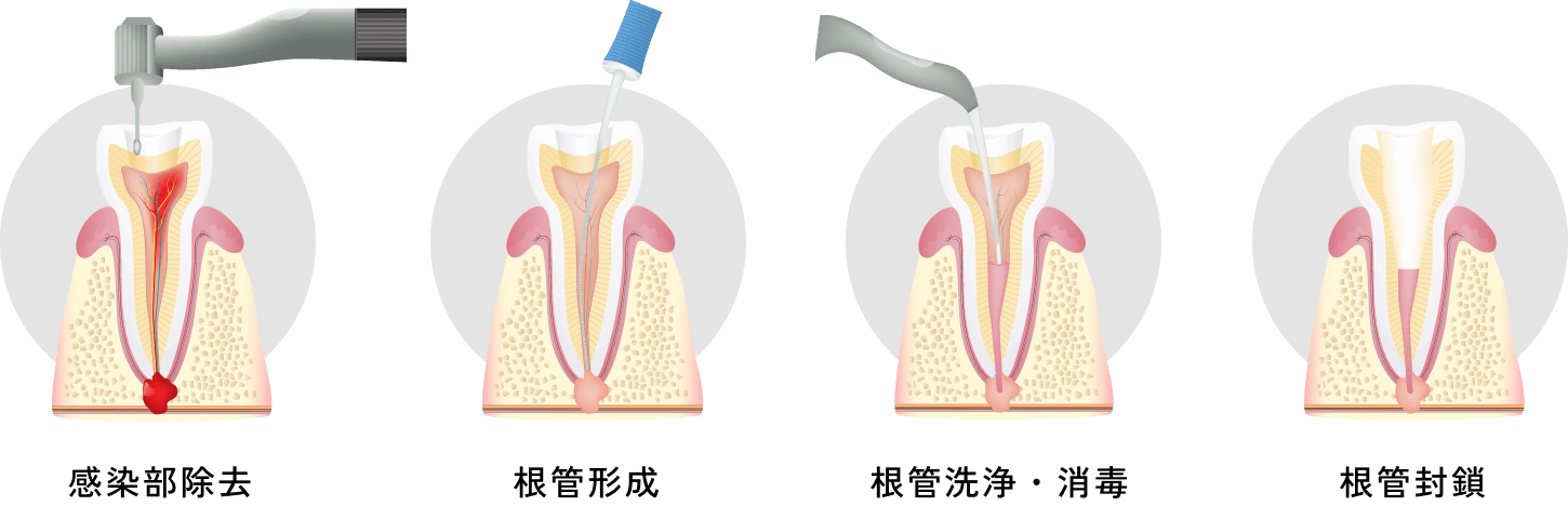 根管治療の流れ