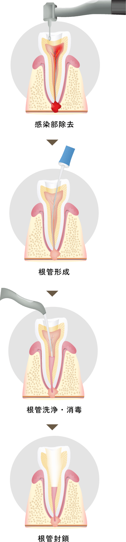 根管治療の流れ