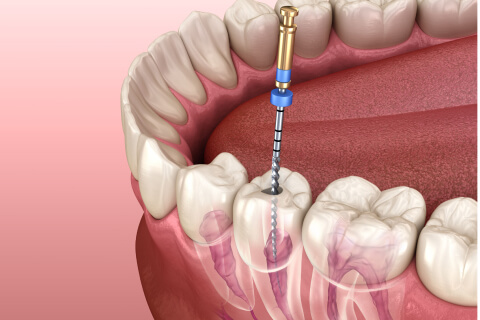 Ni-Tiロータリーファイル