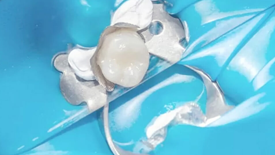 徹底的に菌を排除する欧米式精密根管治療